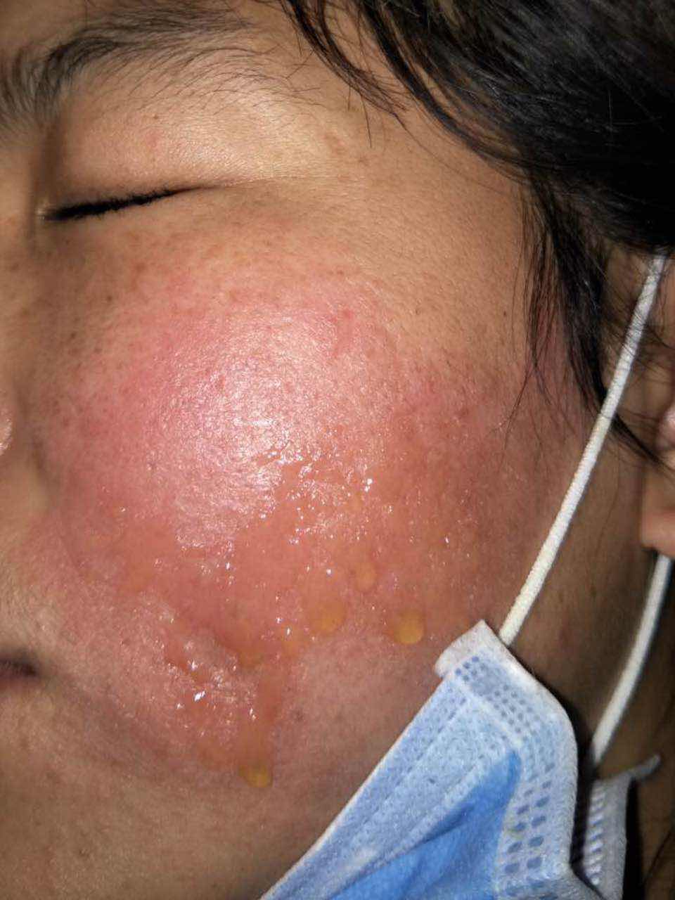 激素脸的危害